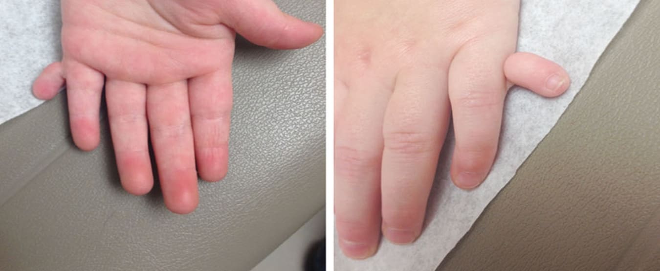 Paediatric hand surgery before treatment