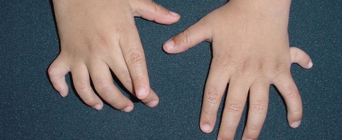 Paediatric hand surgery for congenital hand differences