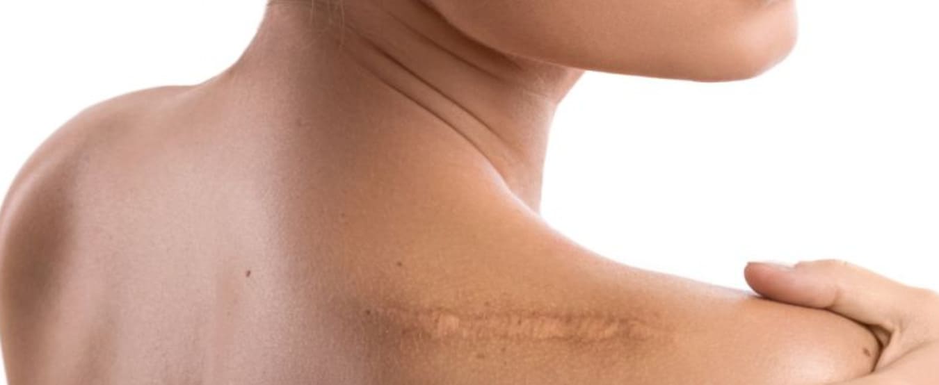 Paediatric scar revision surgery for scars