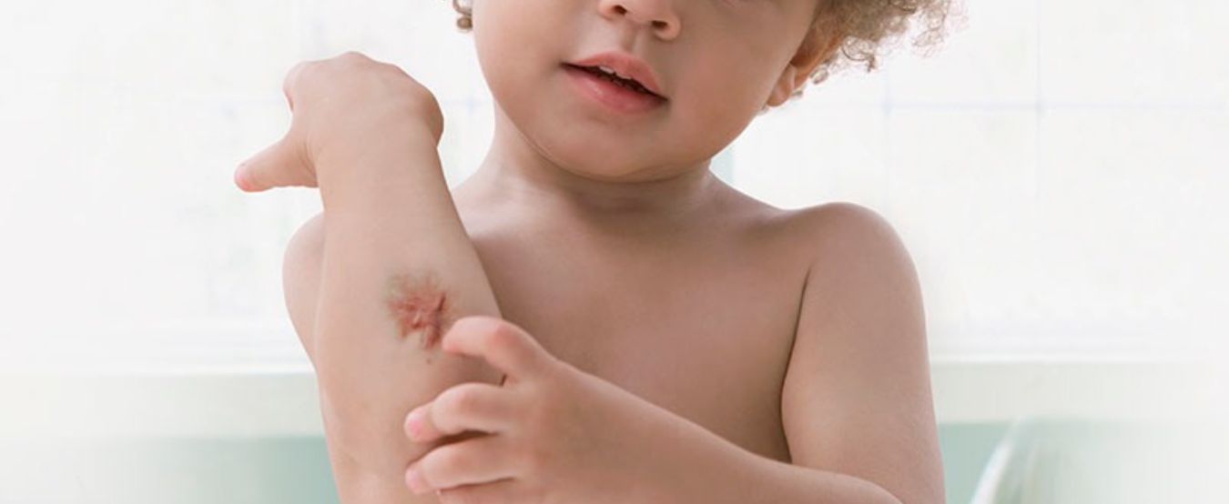 Scar injury treatment services for Children