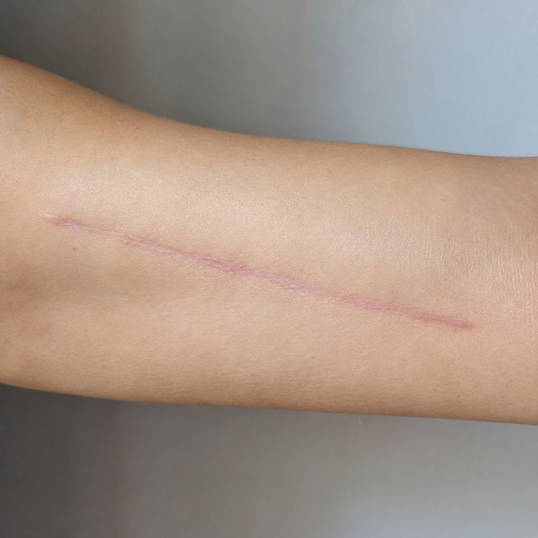 Scar treatment photo